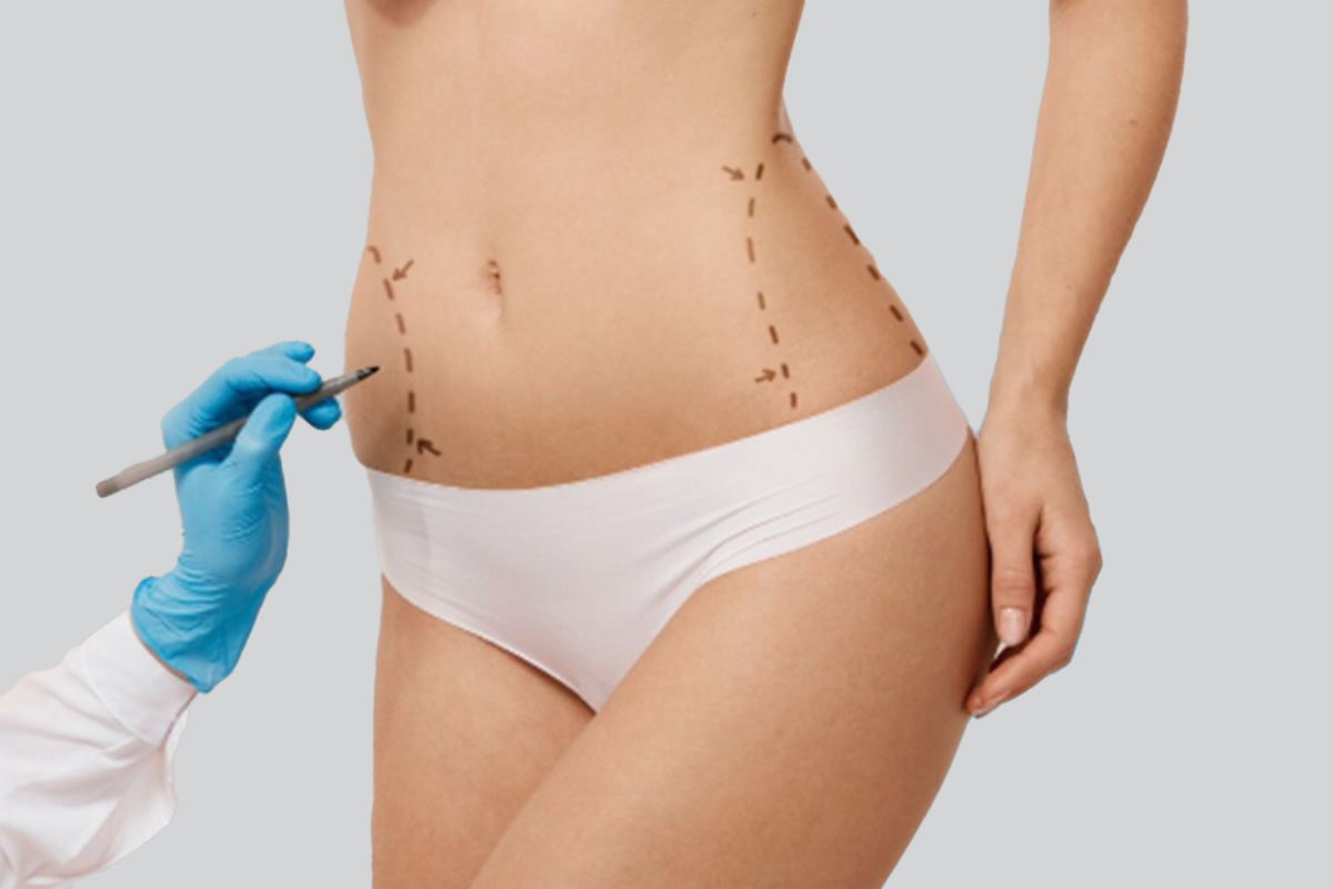 abdominoplastia-en-turquia
