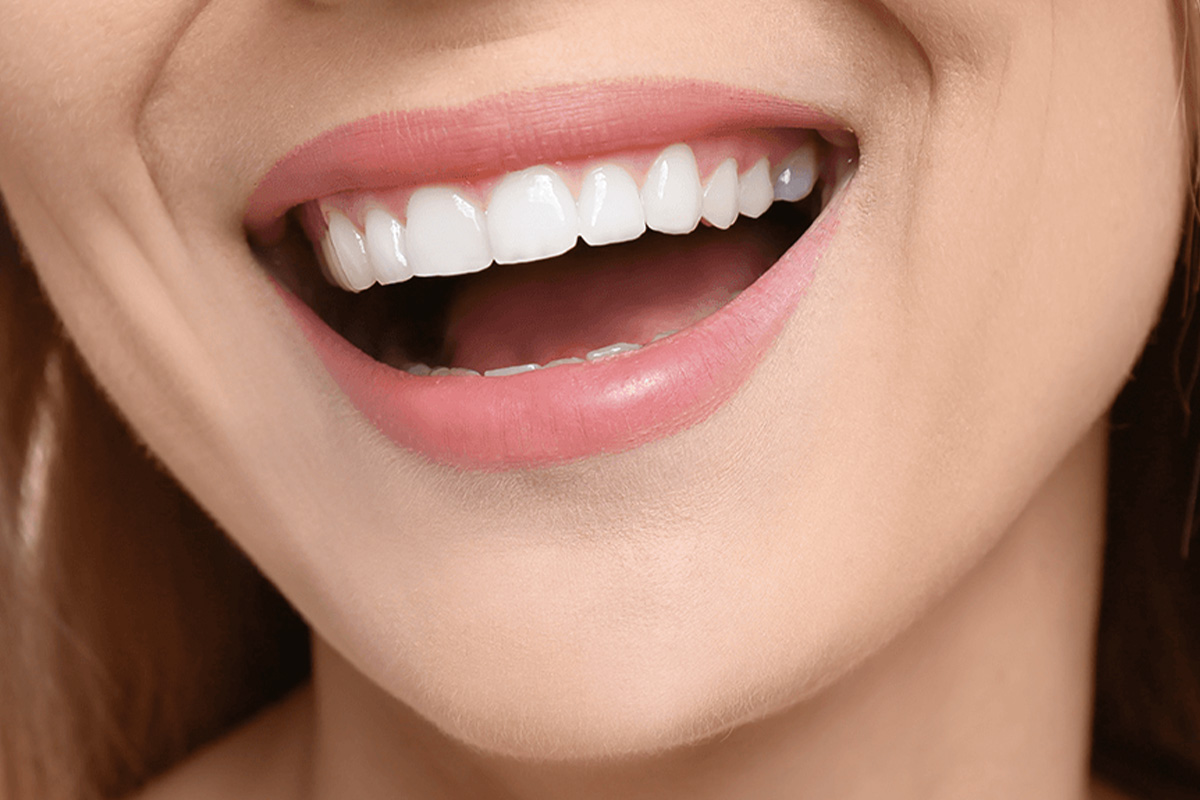 Hollywood Smile en Turquía