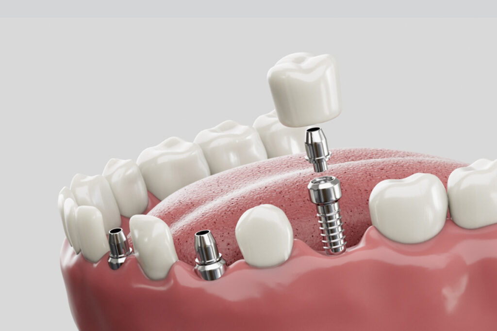Implante Dental en Turquía