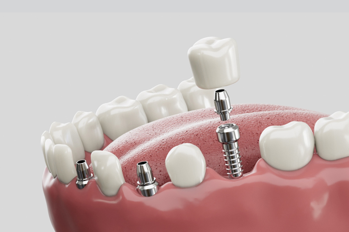 Implante Dental en Turquía